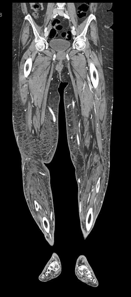 Diffuse Cellulitis with Increased Blood Flow - CTisus CT Scan