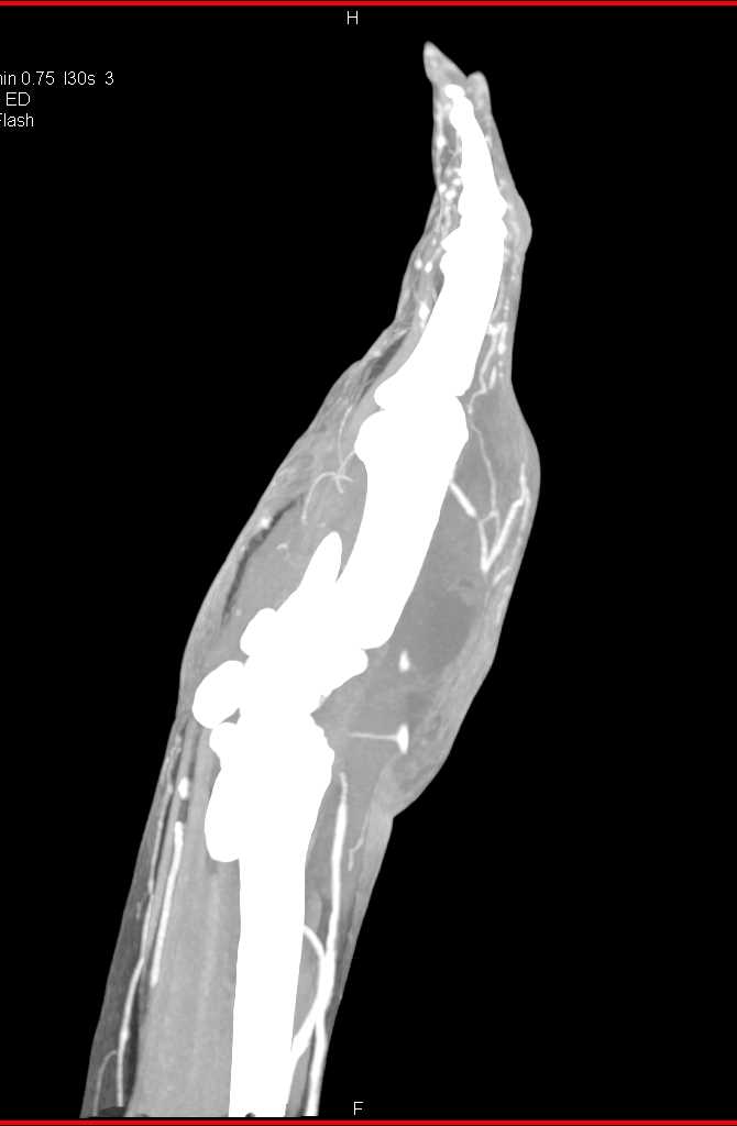 Abscess in the Dorsum of the Hand - CTisus CT Scan