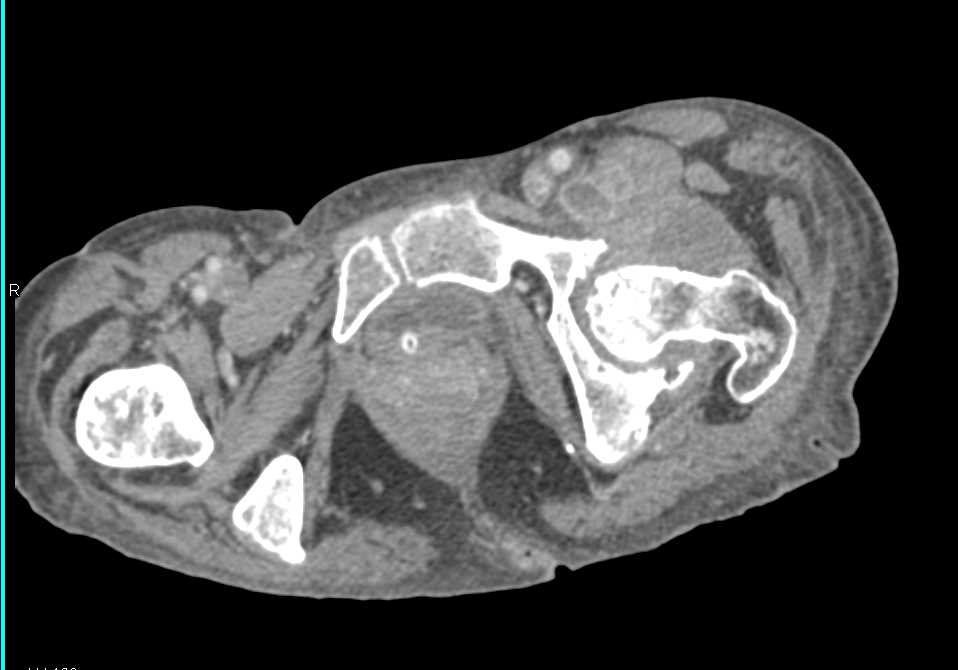 Left Iliopsoas Abscess with Extension to Left Hip Joint - CTisus CT Scan