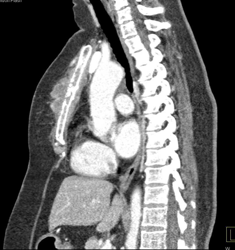 Lymphoma with Tumor Infiltration of the Sternum - CTisus CT Scan