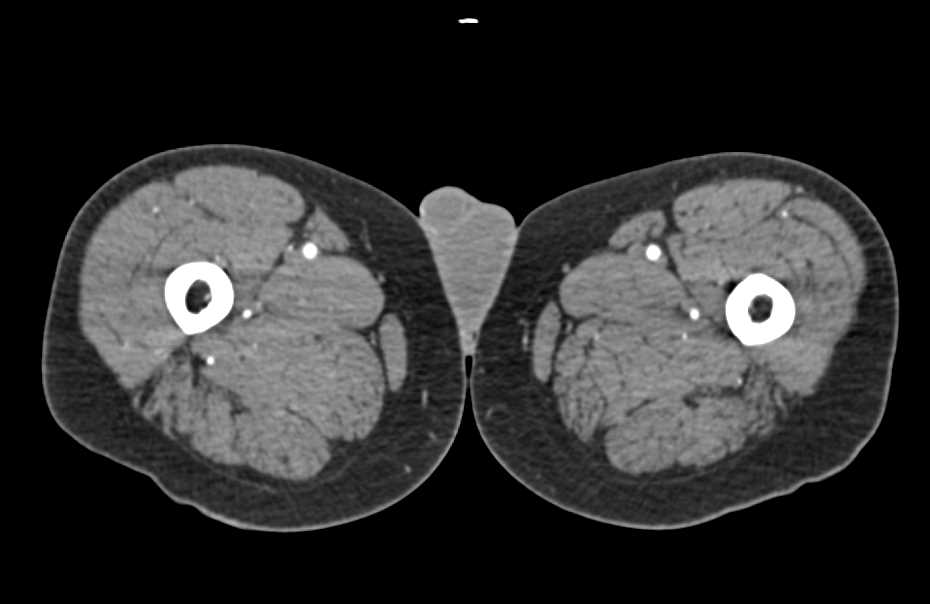 Trauma to the Left Calf - CTisus CT Scan