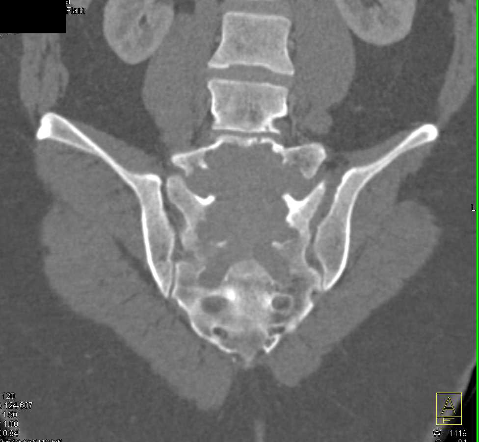 Sacral Chordoma - CTisus CT Scan