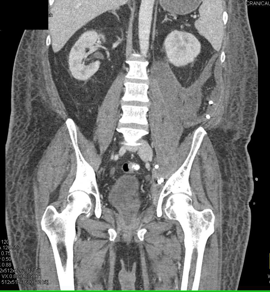 Left Psoas Abscess - CTisus CT Scan