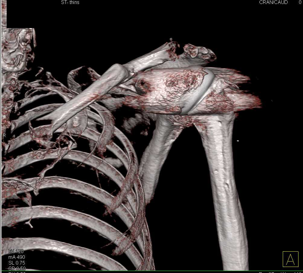 Left Total Shoulder Replacement - CTisus CT Scan
