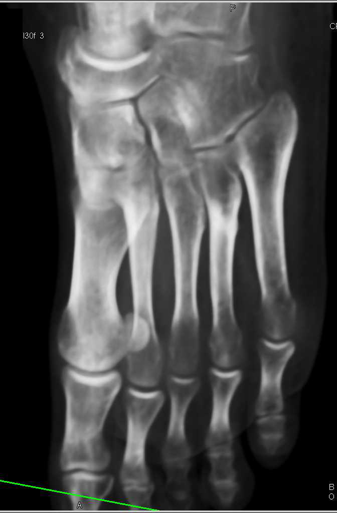 Display of Metatarsals in Multiple Views - CTisus CT Scan
