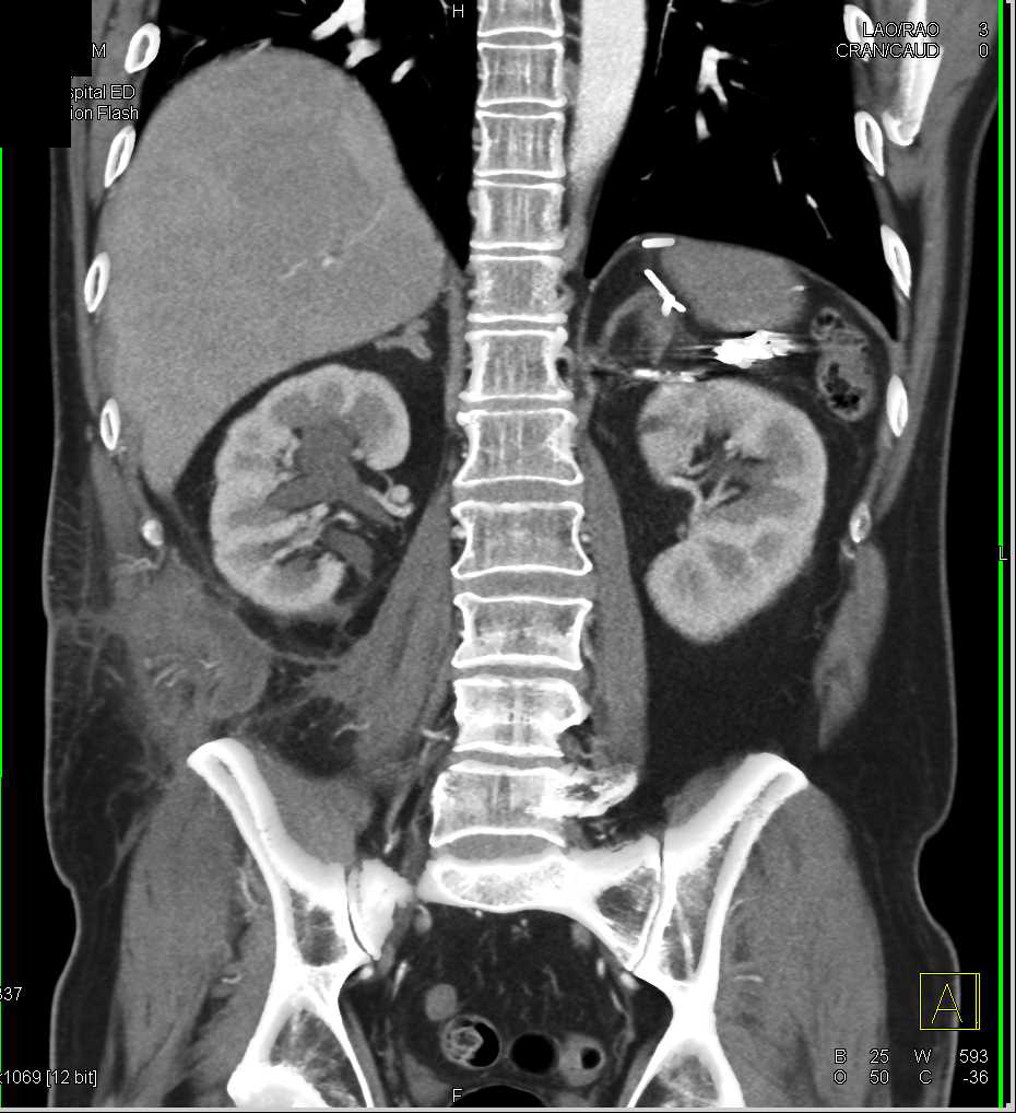 Bleed Involves Psoas and Iliopsoas Muscle - CTisus CT Scan