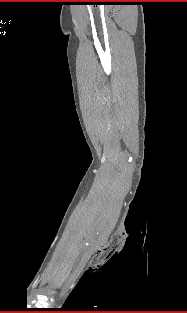 Open Wound Lower Extremity Without Vascular Injury - CTisus CT Scan