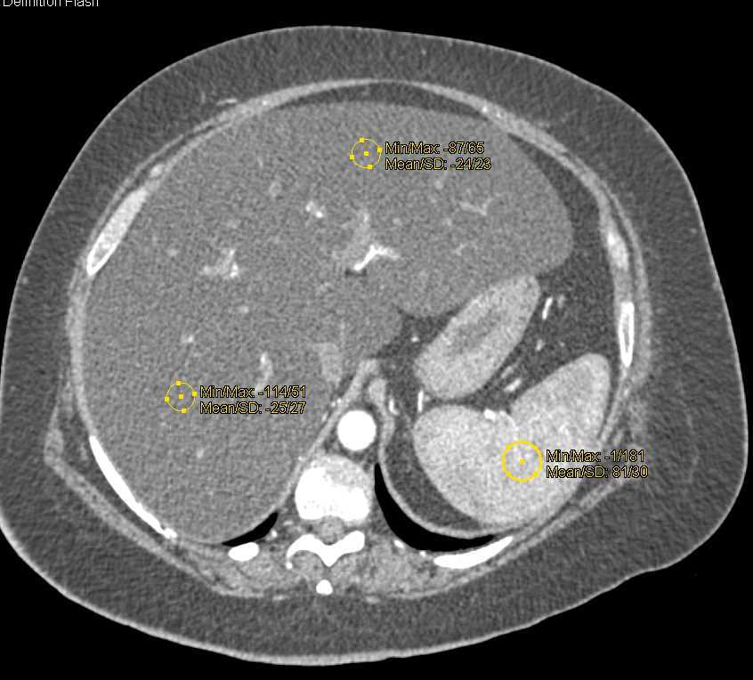 Right Gluteal Hematoma in a Patient with Fatty Liver Disease - CTisus CT Scan