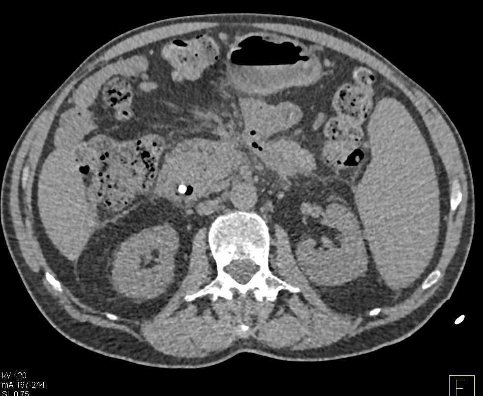 Left Psoas Abscess as a Consequence of Pancreatitis - CTisus CT Scan