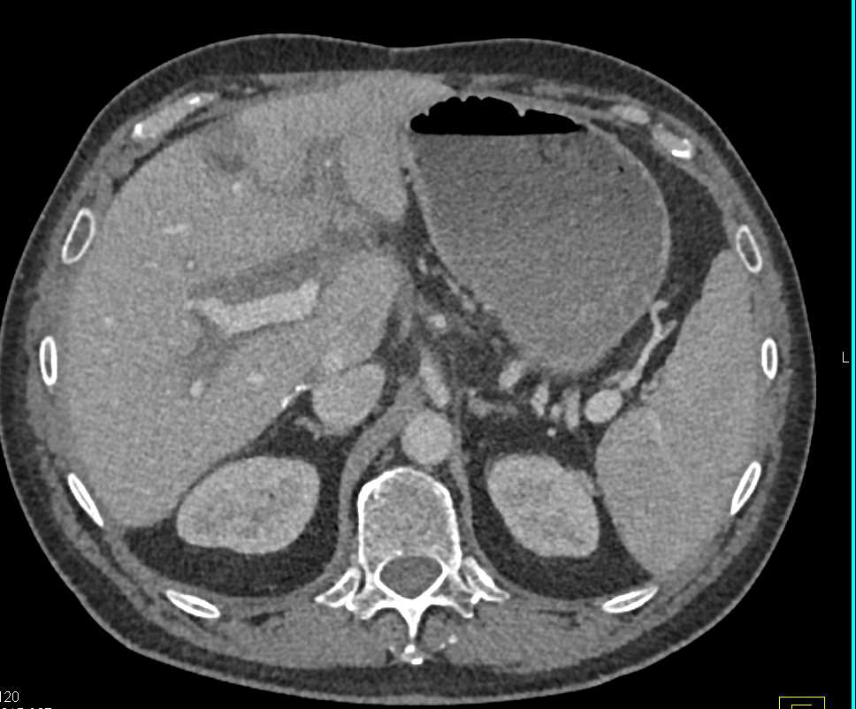Intravenous Drug Abuse (IVDA) with Abscess in Arm and Poor Function Left Kidney - CTisus CT Scan