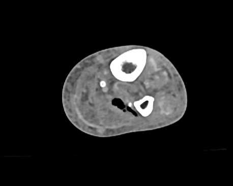 Necrotizing Fasciitis - CTisus CT Scan