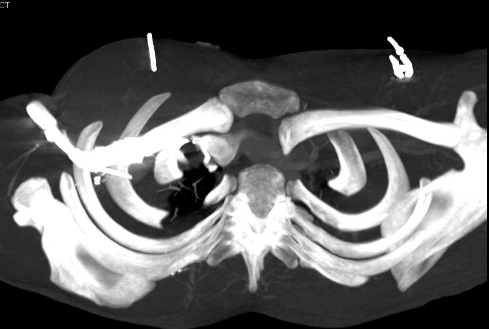 Posterior Dislocation of Left Clavicular Head - CTisus CT Scan