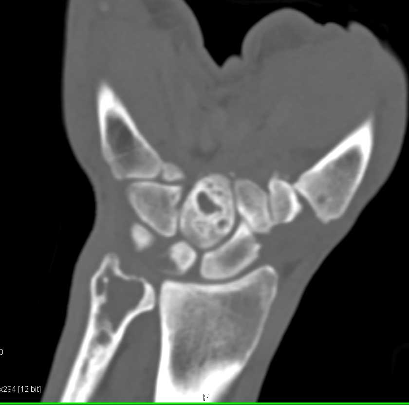 Multiple Cystic Changes in Radius and Carpal Bones - CTisus CT Scan