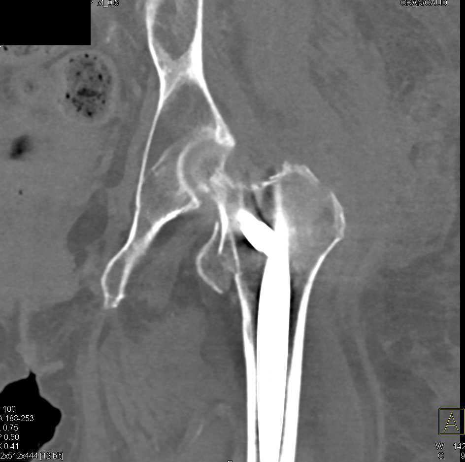 Femur Fracture with Rod in Place - CTisus CT Scan