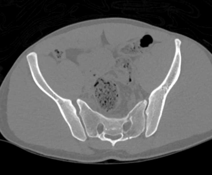 Complex Series of Fractures in Pelvis s/p Motor Vehicle Accident (MVA) - CTisus CT Scan