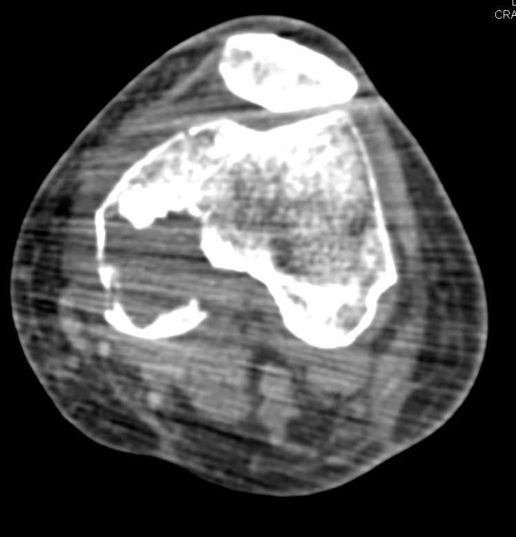 Fractured Aneurysmal Bone Cyst Femur - CTisus CT Scan