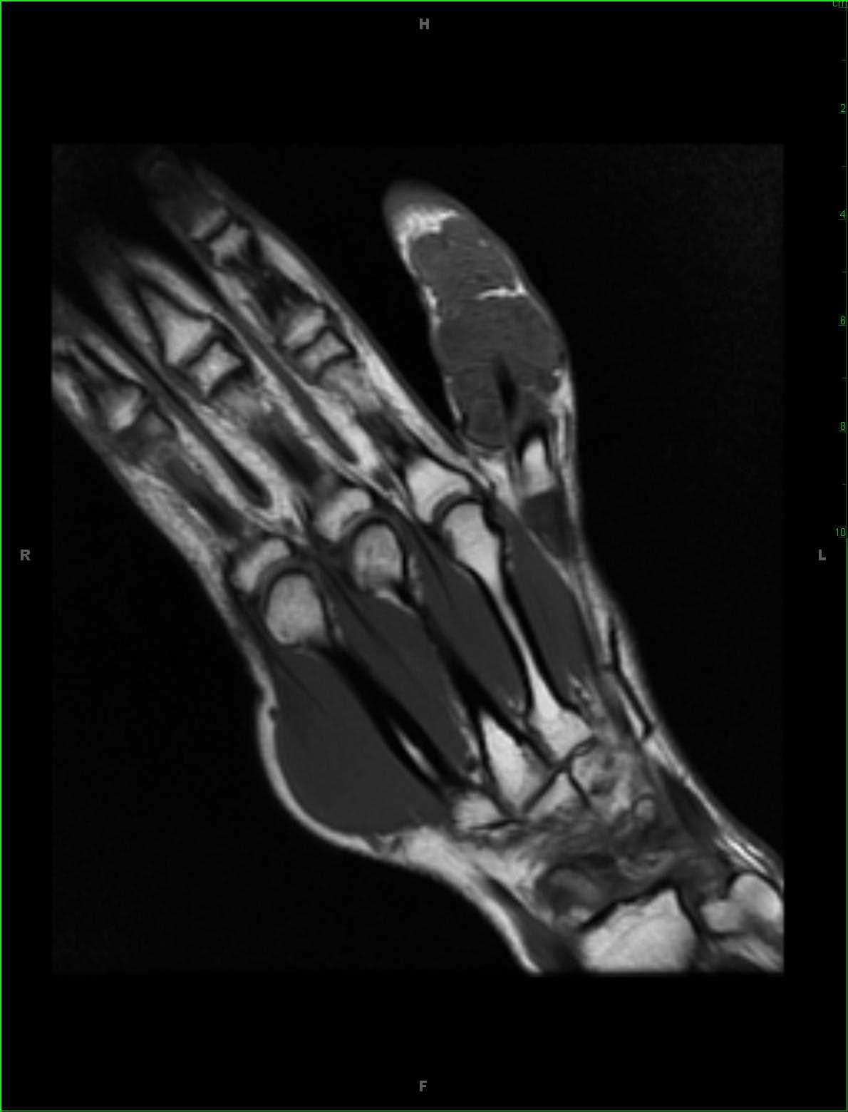 Giant Cell Tumor of the Tendon Sheath, Hand - CTisus CT Scan