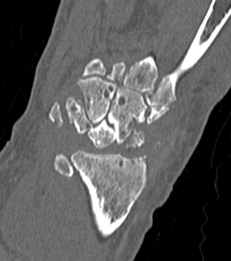 Carpal Bones and Distal Radius Involved by Gout - CTisus CT Scan