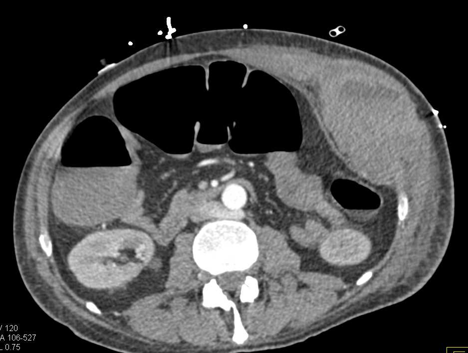 Left Rectus Hematoma with Active Bleed - CTisus CT Scan