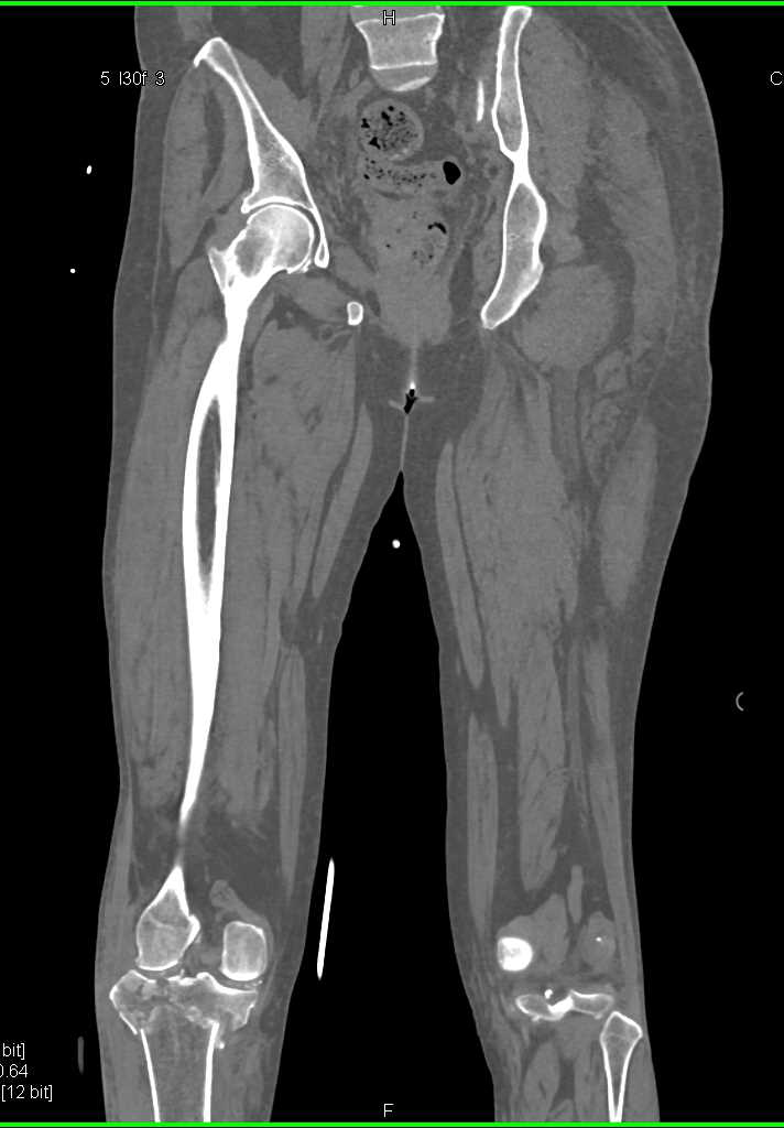 Tibial Plateau Fracture - CTisus CT Scan