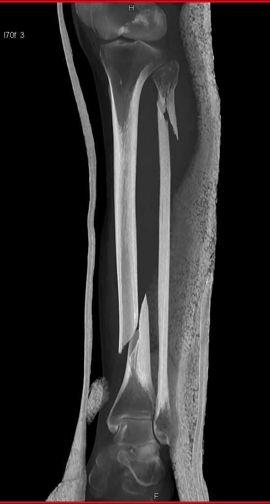 Spiral Fractures of the Tibia and Fibula - CTisus CT Scan