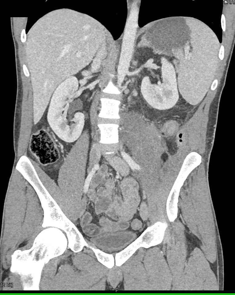 Abscess Involves the Left Psoas Muscle - CTisus CT Scan