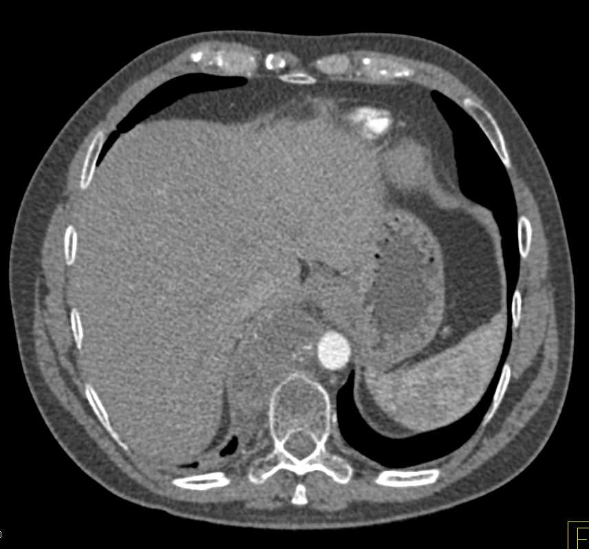 Lymphoma Involves the Spine with Large Soft Tissue Masses - CTisus CT Scan