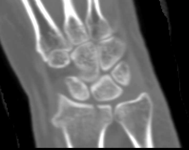 Impacted Fracture Distal Radius - CTisus CT Scan