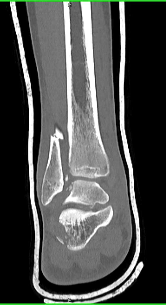 Talus and Calcaneal Fractures - CTisus CT Scan