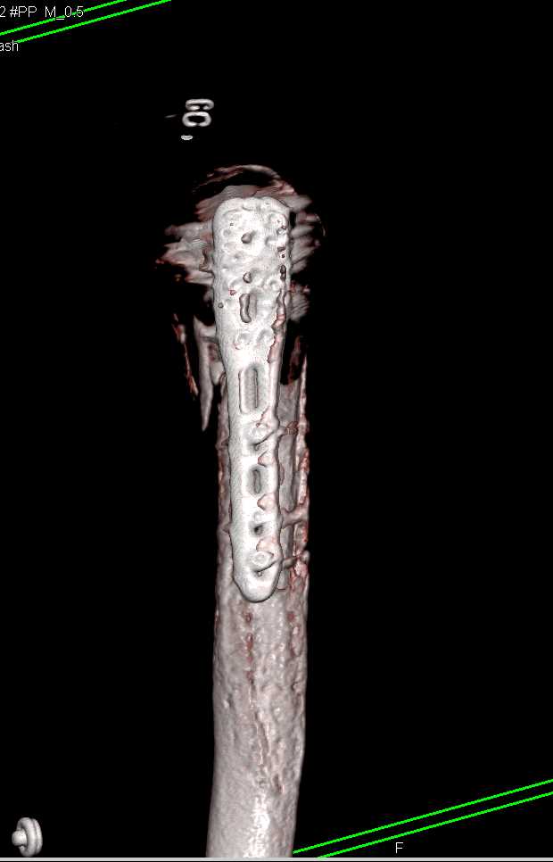 Repair of Proximal Humerus fracture - CTisus CT Scan