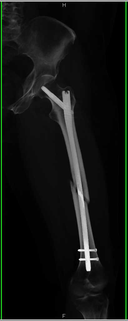 Femur Fracture with Hardware in Place - CTisus CT Scan