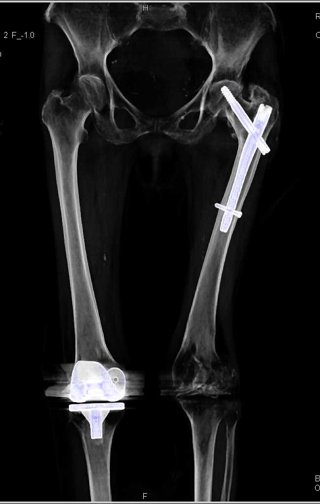 Left Distal Femur Fracture in Patient with Hardware - CTisus CT Scan