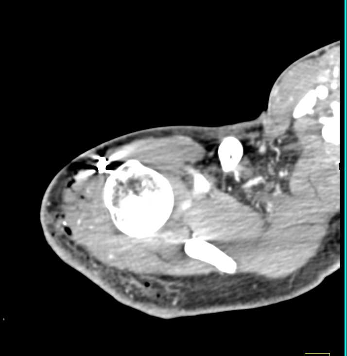 GSW Right Shoulder with Multiple Fractures - CTisus CT Scan
