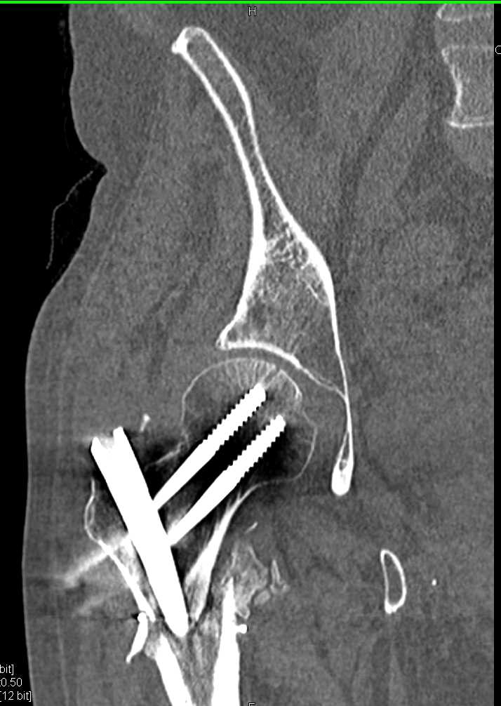 Refracture of Femur with Prior Pinning - CTisus CT Scan