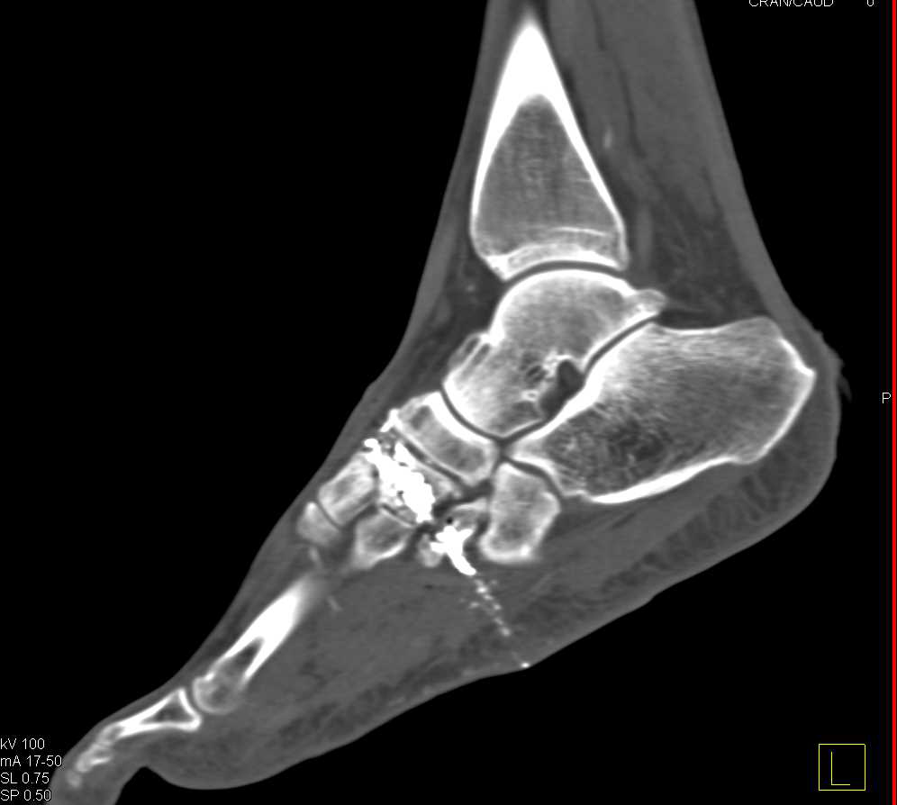 GSW Mid Foot with Fractures - CTisus CT Scan
