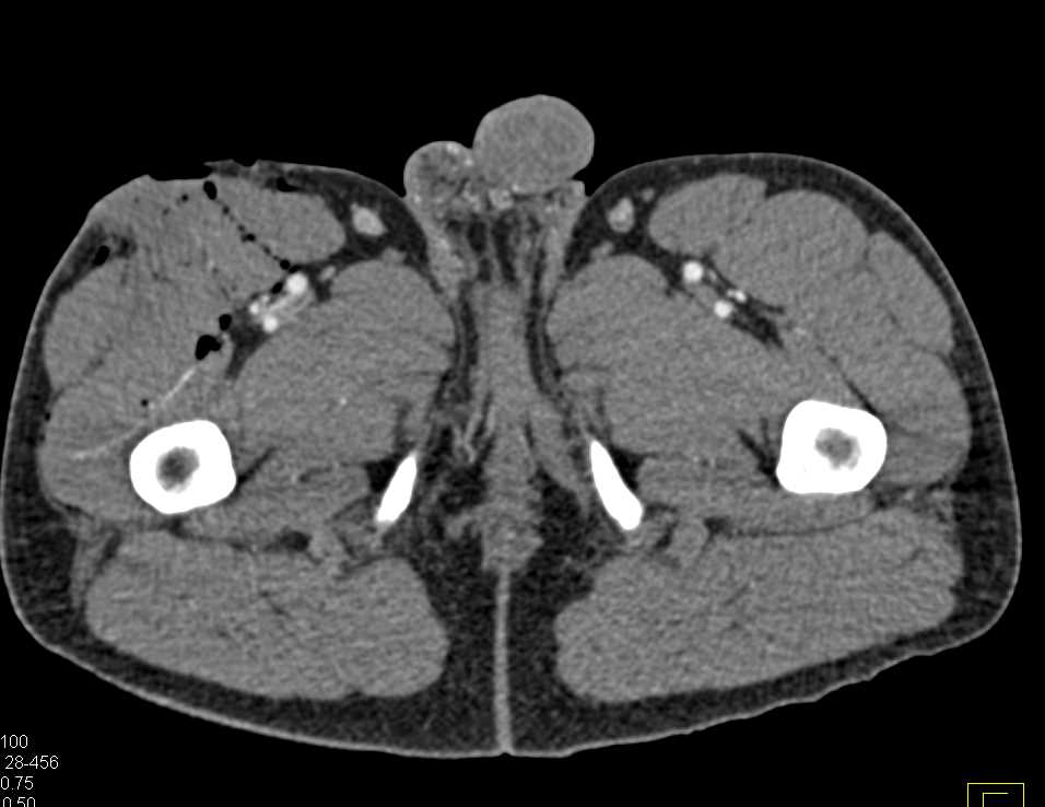 Trauma Right Thigh With No Vascular Injury - CTisus CT Scan