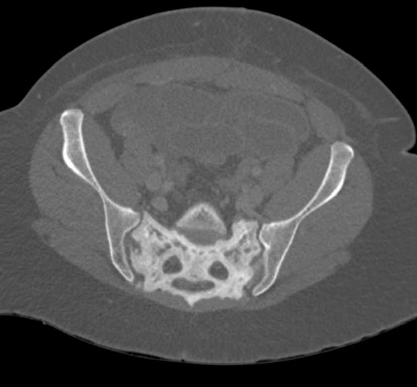 Diffuse Sclerosis of Sacrum - CTisus CT Scan