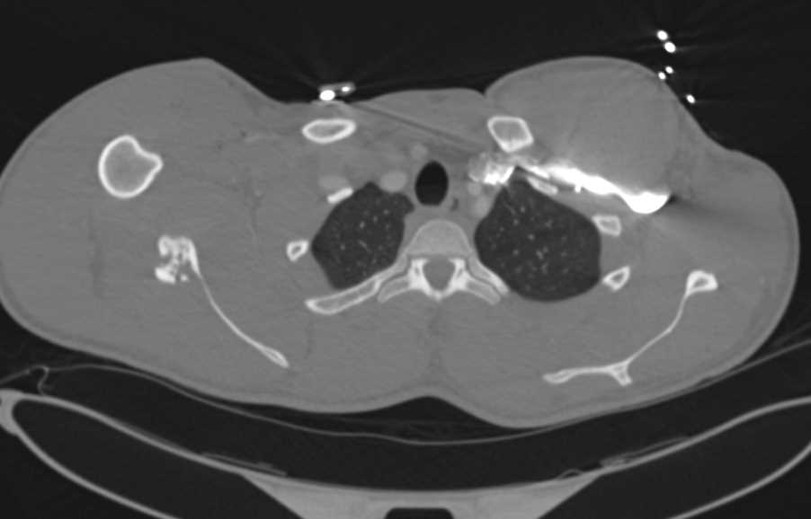 GSW with Scapular Fracture - CTisus CT Scan