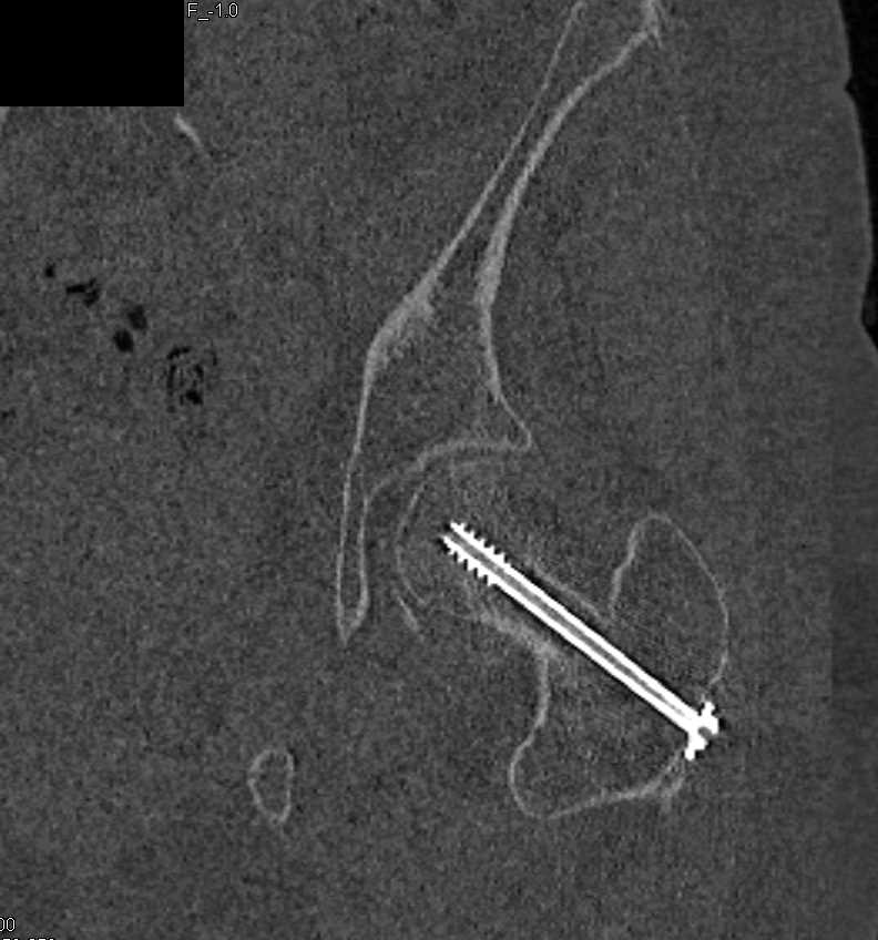 Pins in Left Femur - CTisus CT Scan