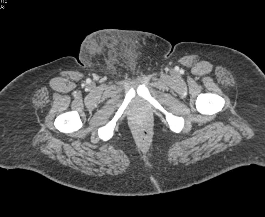 Cellulitis in the Soft Tissue of Pubis - CTisus CT Scan