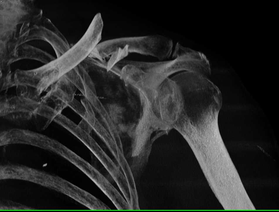 Fracture/Dislocation of the Left Clavicle - CTisus CT Scan