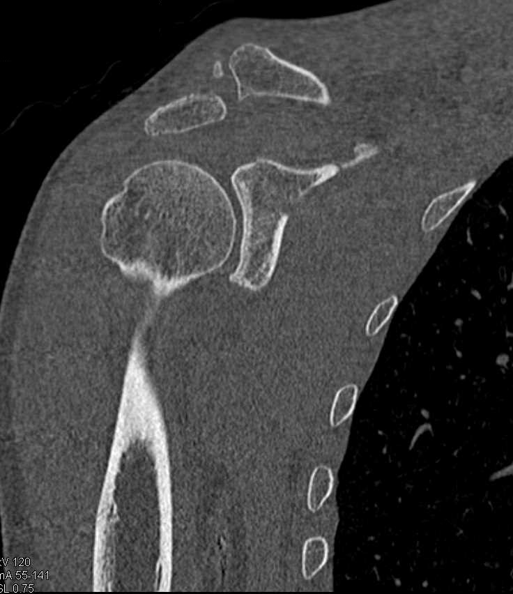 Glenoid Fracture and Widening of the AC Joint - CTisus CT Scan
