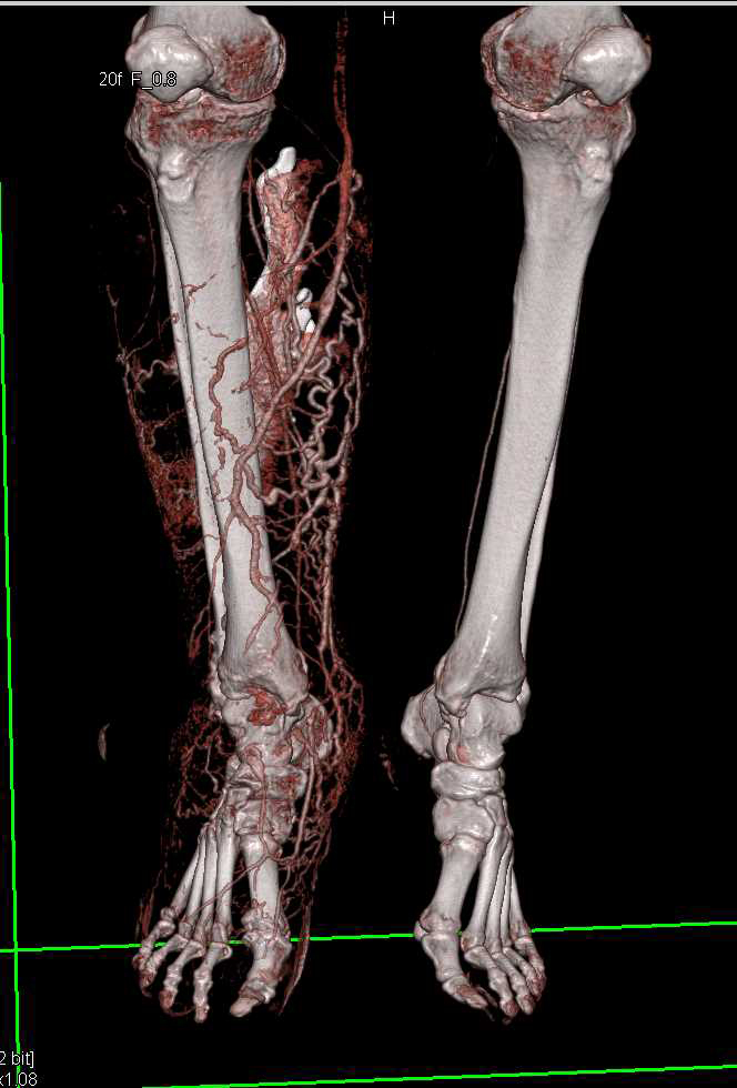 Lymphedema Right Calf and Foot - CTisus CT Scan
