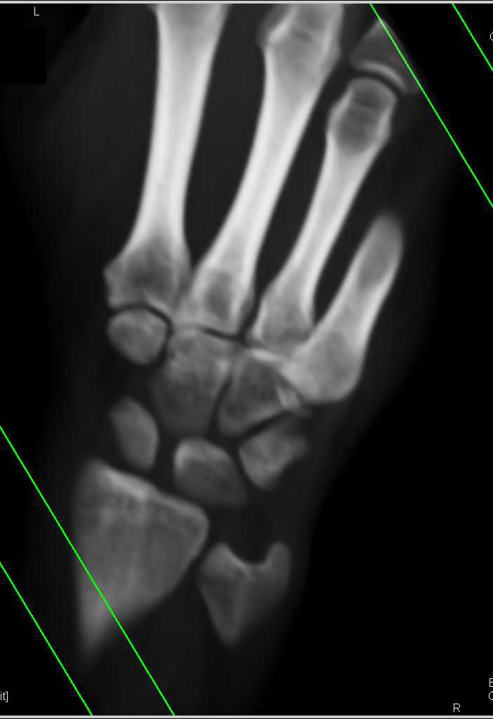 Fracture of the Base of the 5th Metatarsal - CTisus CT Scan