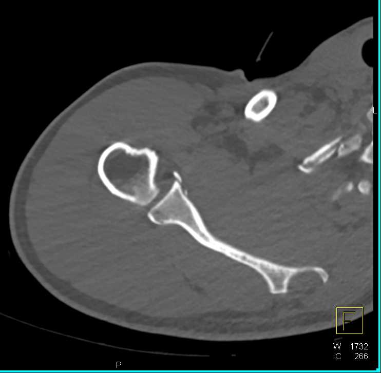 Scapular Fracture - CTisus CT Scan
