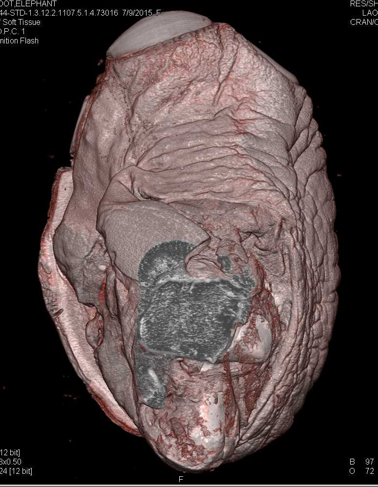 Elephant Foot in 3D - CTisus CT Scan