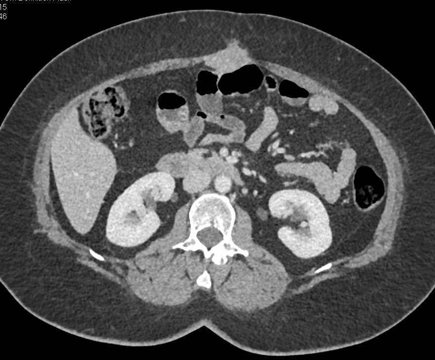 Desmoid Tumor Abdominal Wall - CTisus CT Scan