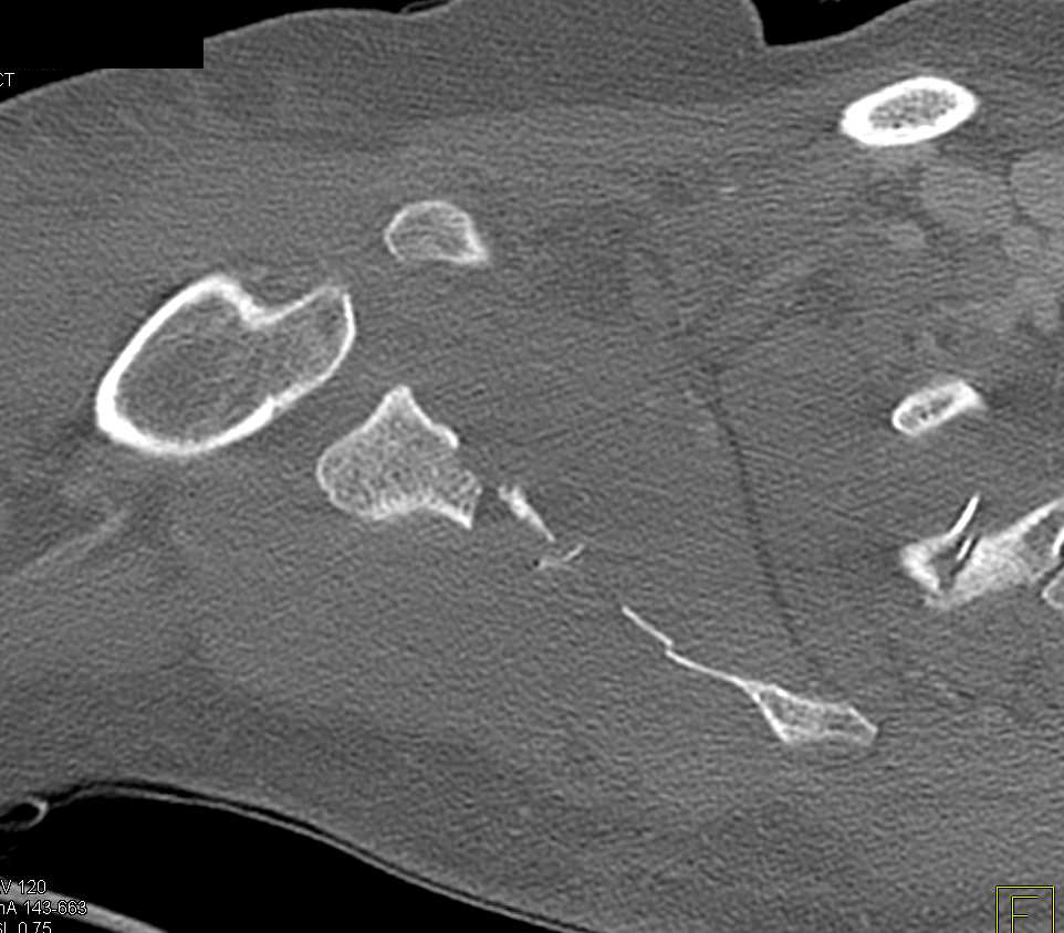 Comminuted Scapular Fracture - CTisus CT Scan