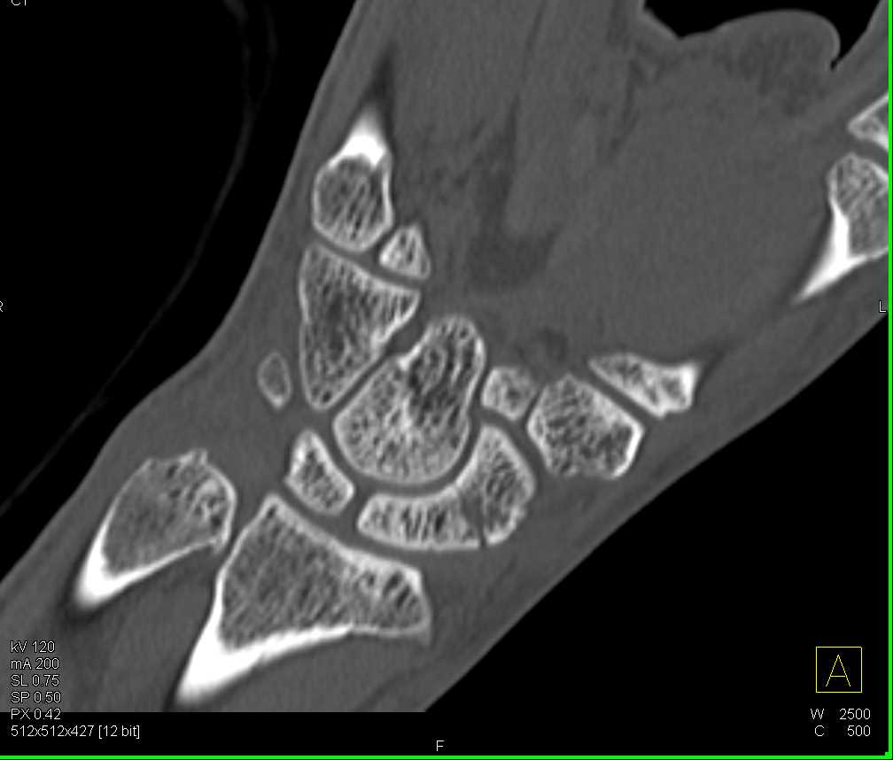 Scaphoid Fracture - CTisus CT Scan
