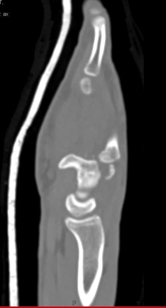 Multiple Carpal Fractures in 3D - CTisus CT Scan